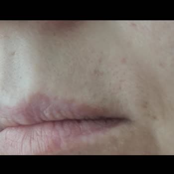 Mehtap Uluğturhan İğneli Epilasyon Sonrası İz Kaldı!