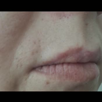 Mehtap Uluğturhan İğneli Epilasyon Sonrası İz Kaldı!