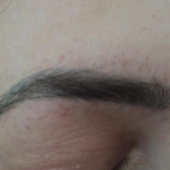 Mehtap Uluğturhan İğneli Epilasyon Sonrası İz Kaldı!