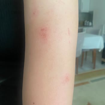 Hassas Ciltler İçin Aldığım Tüy Dökücü Krem Cildimde Ciddi Yanma Yaptı