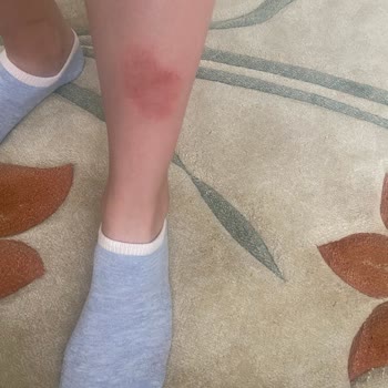 Hassas Ciltler İçin Aldığım Tüy Dökücü Krem Cildimde Ciddi Yanma Yaptı