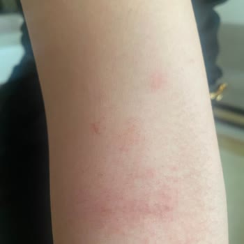 Hassas Ciltler İçin Aldığım Tüy Dökücü Krem Cildimde Ciddi Yanma Yaptı