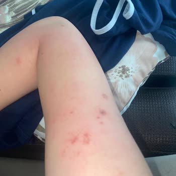 Hassas Ciltler İçin Aldığım Tüy Dökücü Krem Cildimde Ciddi Yanma Yaptı