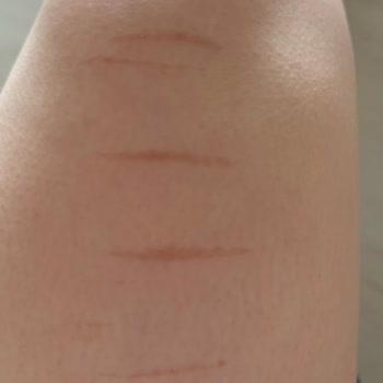 Lazer Epilasyon Sonrası Bacakta Kalıcı İz Ve Yetersiz Destek