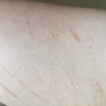 Lazer Epilasyon Sonrası Bacakta Kalıcı İz Ve Yetersiz Destek