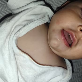 Sma Comfort Mama Sonrası Bebeğimde Alerji Ve Kızarıklık Oluştu