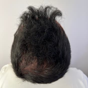 Esteworld'de Eksozom Tedavisinde Fotoğraf Manipülasyonu