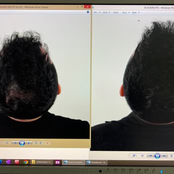 Esteworld'de Eksozom Tedavisinde Fotoğraf Manipülasyonu