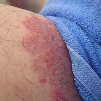 Veet Krem Cildimde Kalıcı Tahrişe Neden Oldu