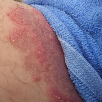 Veet Krem Cildimde Kalıcı Tahrişe Neden Oldu