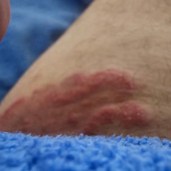 Veet Krem Cildimde Kalıcı Tahrişe Neden Oldu