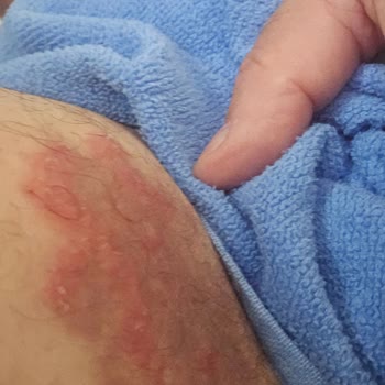 Veet Krem Cildimde Kalıcı Tahrişe Neden Oldu