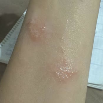 Aceite Pink de Victoria's Secret causa ronchas y reacción severa en piel