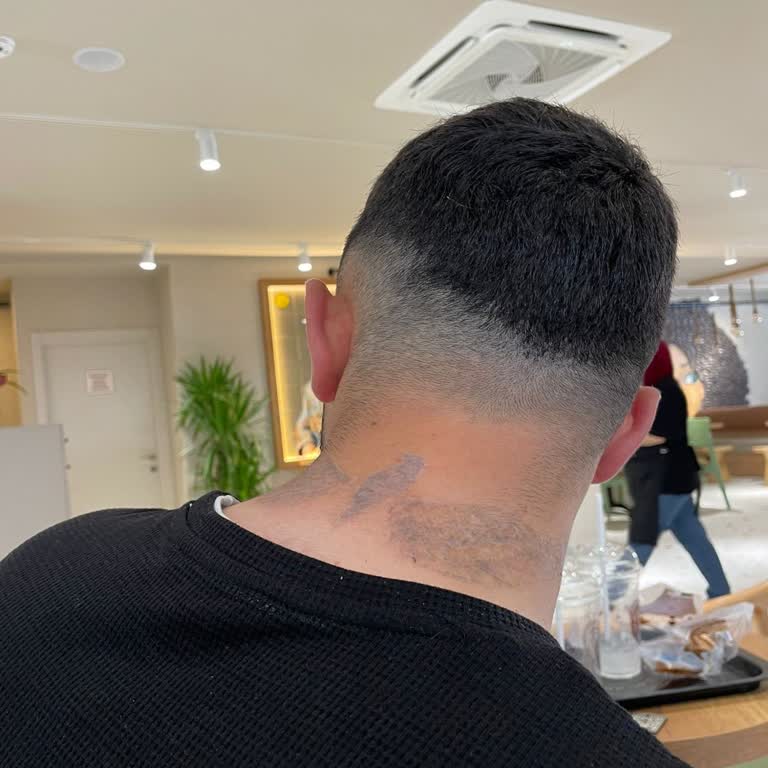 Dövme Sildirme İşleminde Mağduriyet Ve Yanlış Yönlendirme