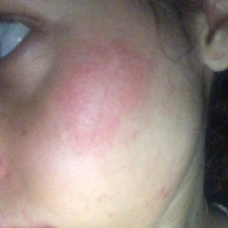 Beaulis Ürünü Yüzümde Ciddi Ölçüde Alerji Yaptı!