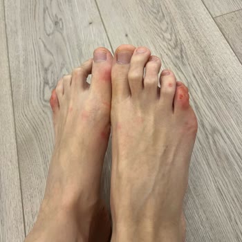 Hakiki Deri Sandaletin Metal Parçası Kırıldı, Ayağım Yaralandı Ve İade Sürecinde Mağduriyet Yaşıyorum