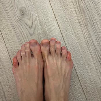 Hakiki Deri Sandaletin Metal Parçası Kırıldı, Ayağım Yaralandı Ve İade Sürecinde Mağduriyet Yaşıyorum