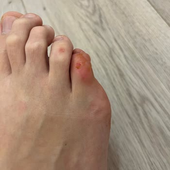 Hakiki Deri Sandaletin Metal Parçası Kırıldı, Ayağım Yaralandı Ve İade Sürecinde Mağduriyet Yaşıyorum