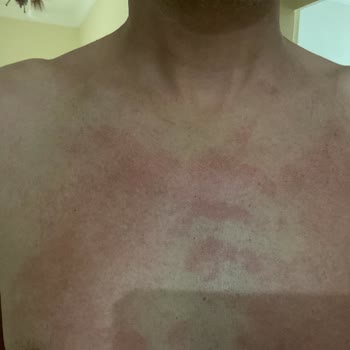 Ürün Kullanımı Sonrası Ciltte Alerjik Reaksiyon