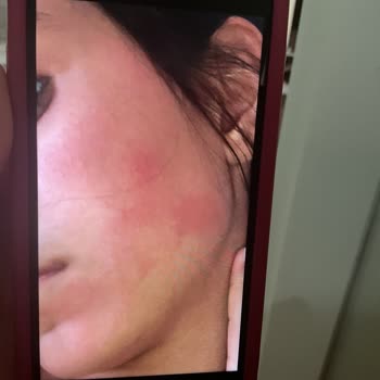 Ürün Kullanımı Sonrası Ciltte Alerjik Reaksiyon