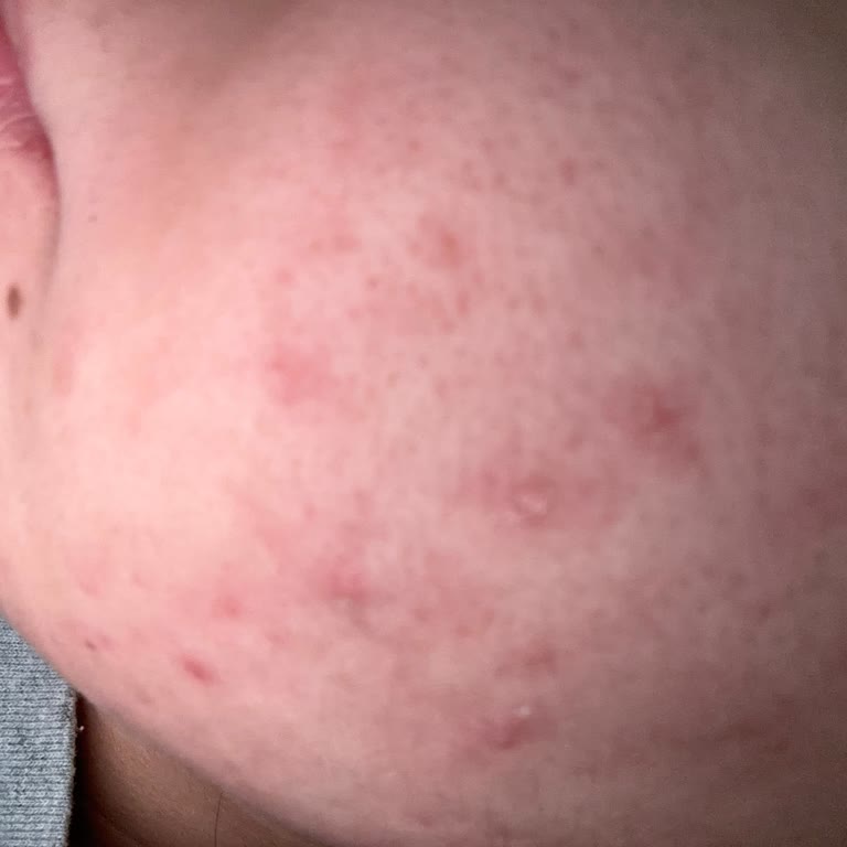 La Roche Posay Leke Serumu Cildimi Mahvetti