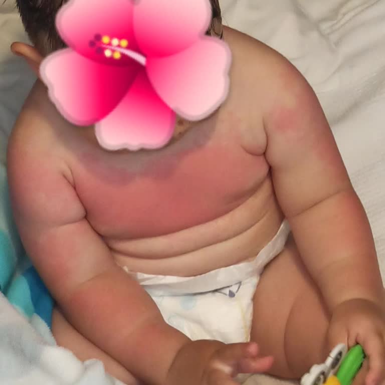 Mustela Güneş Kremi Sonrası Bebeğimde Ciddi Cilt Kızarıklığı Ve Kabarma Yaşadık