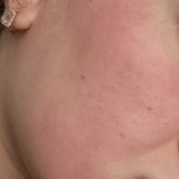 Kullandığım Yüz Kremi Cildimde Yanma Ve Şişmeye Sebep Oldu