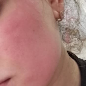 Kullandığım Yüz Kremi Cildimde Yanma Ve Şişmeye Sebep Oldu