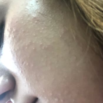 Sinoz Ciltte Yanık Ve Tahrişe Sebep Olan Ürün Hayal Kırıklığı Yarattı