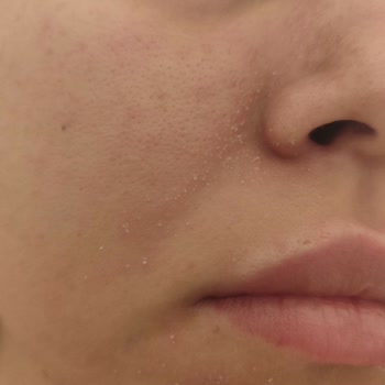 Sinoz Facial Cleanser Caused Redness and Peeling on My Skin