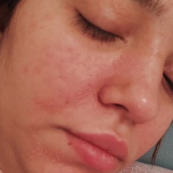 Sinoz Facial Cleanser Caused Redness and Peeling on My Skin