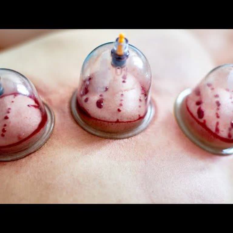 Yanlış Hacamat Tekniğiyle Sağlığım Bozuldu