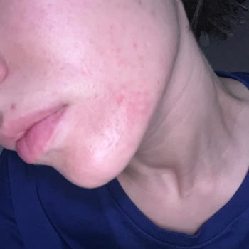 Bioxcin Leke Karşıtı Güneş Kremi Cildimde Sorun Oluşturdu