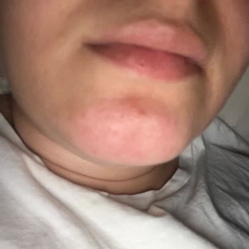 Kullandığım Nemlendirici Cildimi Mahvetti: Kaşıntı, Yanma Ve Sivilce Sorunu