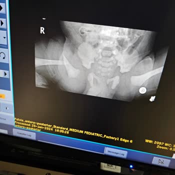 Sezaryen Doğumda Bebeğimin Bacağı Kırıldı, Sıfır Sorumluluk!