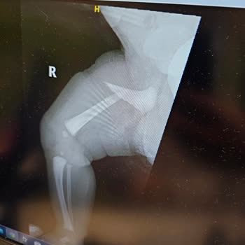 Sezaryen Doğumda Bebeğimin Bacağı Kırıldı, Sıfır Sorumluluk!