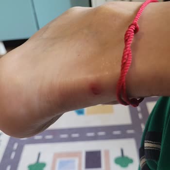 Adidas Samba Modeli Ayağımı Yara Yaptı, Mağduriyetimin Giderilmesini İstiyorum