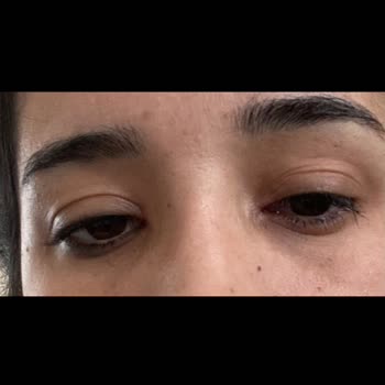 Gratis'ten Aldığım Rimel Gözümde Ciddi Sağlık Sorununa Yol Açtı