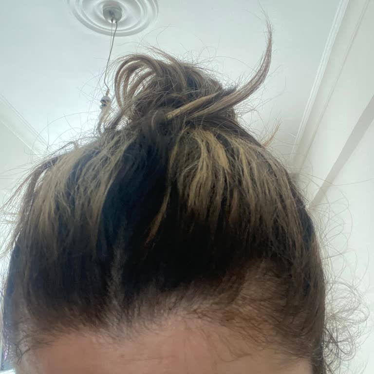 Ombre İşlemi Sonrası Teknik Hata Ve Sorumsuz Yaklaşım Nedeniyle Mağduriyet