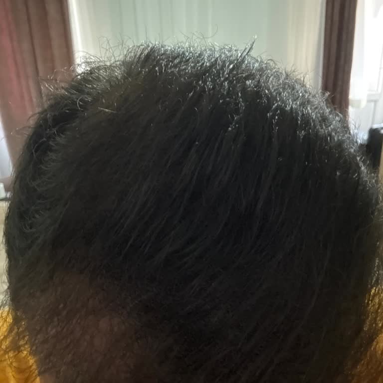 Bioxcin Şampuan Saç Dökülmesini Artırdı, Büyük Hayal Kırıklığı Yaşadım