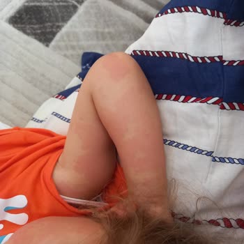 Siveno Sivrisinek Kovucu Sprey Çocuğumda Şiddetli Alerjiye Sebep Oldu