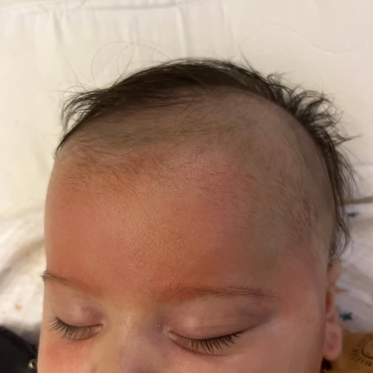 Bebeğimde Mustela Ürünleri Sonrası Ciltte Kızarıklık Ve Yan Etki Şikayeti