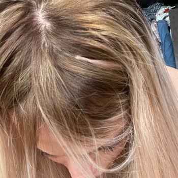 Saç Kaynak Merkezinde Kötü Hizmet Ve Mağduriyet Yaşadım