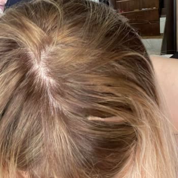 Saç Kaynak Merkezinde Kötü Hizmet Ve Mağduriyet Yaşadım