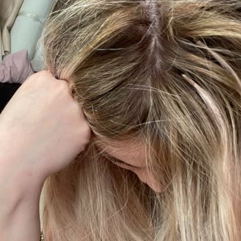 Saç Kaynak Merkezinde Kötü Hizmet Ve Mağduriyet Yaşadım