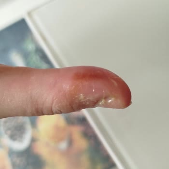 Neşe Oymak Güzellik Merkezi Tırnak İşlemi Sonrası Tırnaklarım Diplerim İltihaplandı