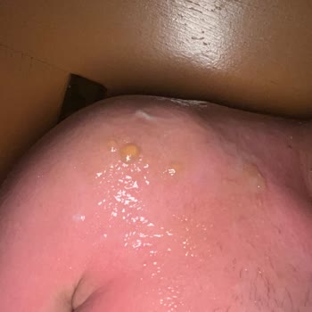 Eda Taşpınar Ürünü Omuzlarımda Su Kabarcıkları Yaptı Tatilim Zehir Oldu