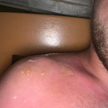 Eda Taşpınar Ürünü Omuzlarımda Su Kabarcıkları Yaptı Tatilim Zehir Oldu