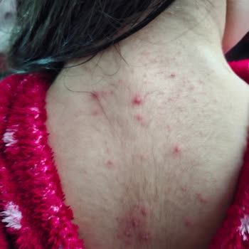 Yeni Elidor Şampuan Çocuğumda Ciddi Saç Derisi Yaralarına Yol Açtı