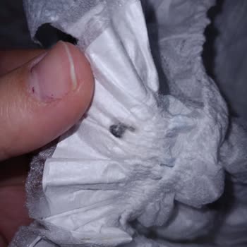 Bebek Bezinde Çıkan Siyah Yabancı Cisim Endişesi